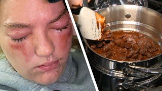 Exploding Chocolate Nearly Blinds 19-Year-Old Student