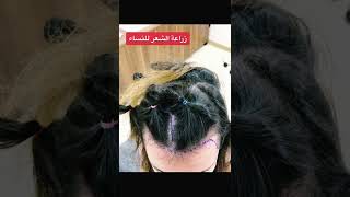 زراعة الشعر للنساء الخليج السعودية الكويت