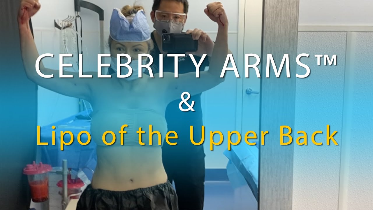Arm Liposuction Immediate Results Celebrity Arms™ Lipo 360 Arms