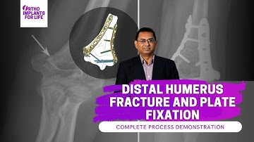 Distal Humerus Fracture & Plate Fixation