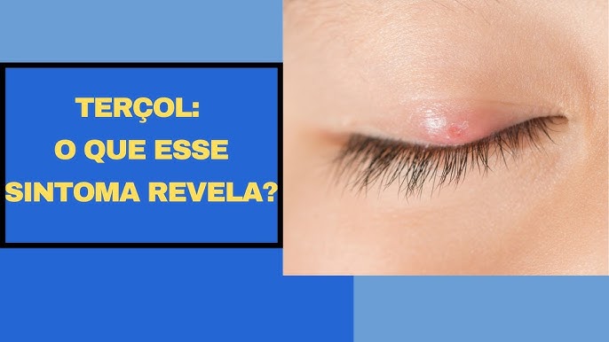 Terçol: causa, sintomas e tratamento - Instituto de Medicina Ocular Dr.  Ricardo Sallum