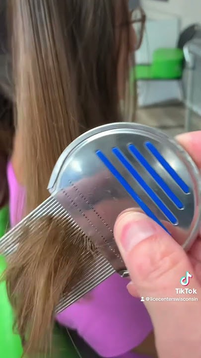 can-you-have-eggs-in-your-hair-but-not-actually-have-lice-lice
