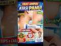 Panu Hilang Dalam Hitungan Minggu?! Fakta Miconazole yang Jarang Diketahui