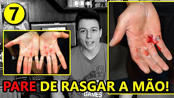 Como acabar com calos na palma da mão?