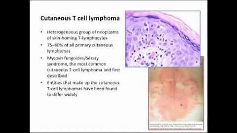 LMP: Optimal Diagnostic Methods with T Cell Lympho...