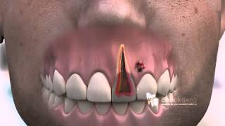 How to treat a dental Fistula