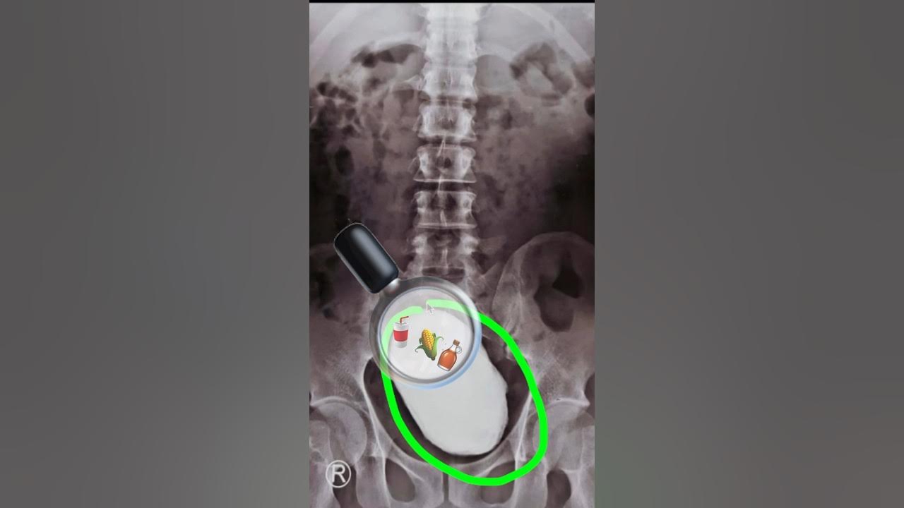 this-32-year-old-had-severe-abdominal-pain-blood-in-urine-emergency