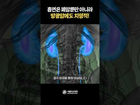 흡연은 폐암뿐만 아니라 방광암에도 치명적!