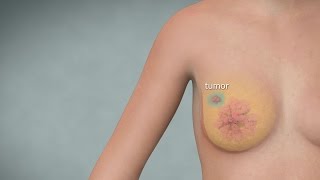 Understanding skin-sparing and nipple-sparing mastectomies