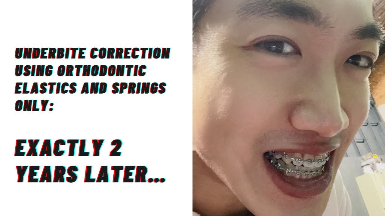 Underbite Correction Using Orthodontic Elastics And Springs Exactly 2