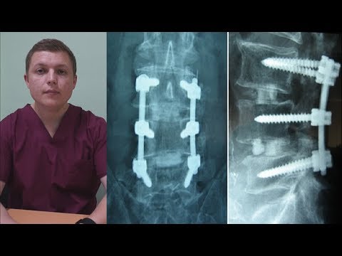 О Минусах Тпф Операции | Spinal Fusion Is It Worth It
