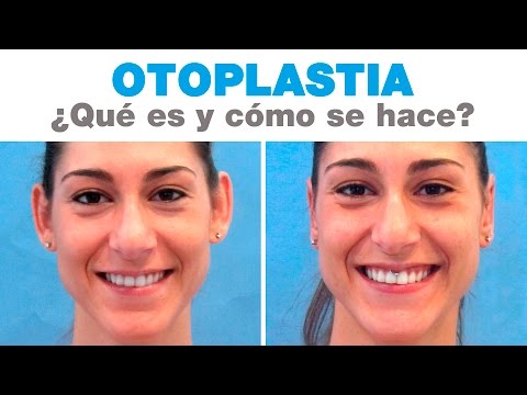 Otoplastia: Qué es