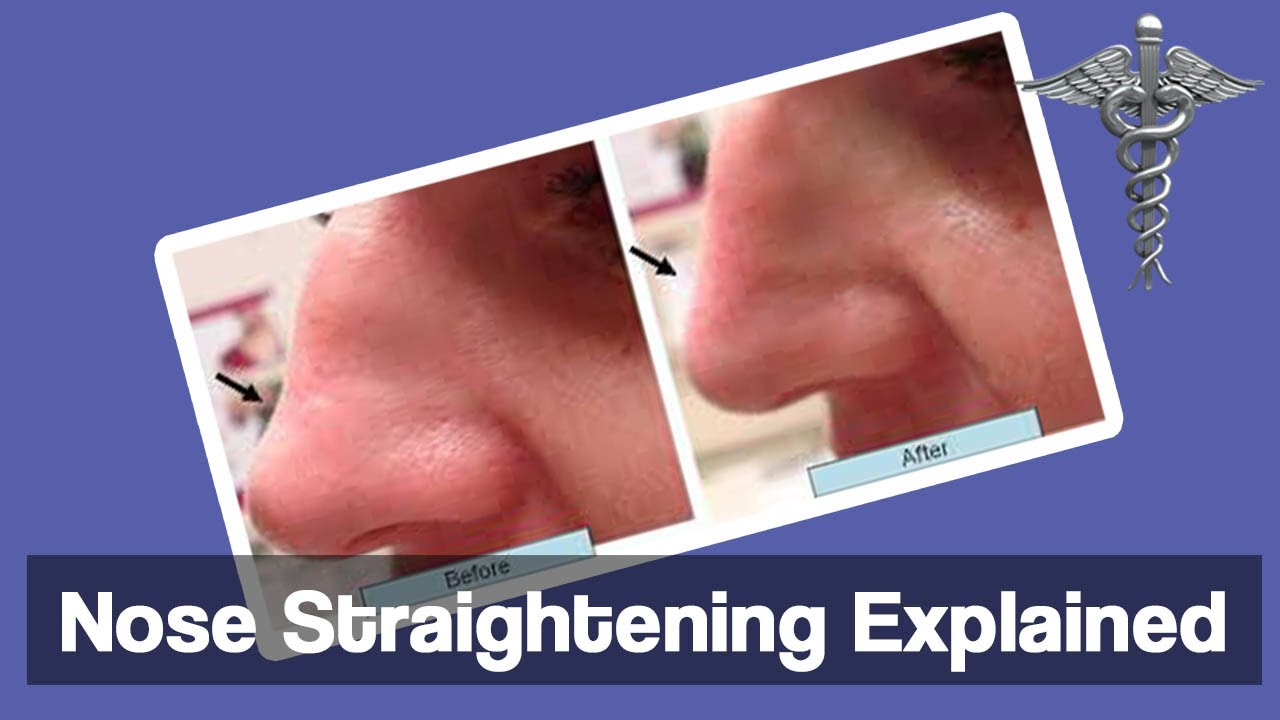Nose Straightening Explained A Plastic/Cosmetic Surgery Operation