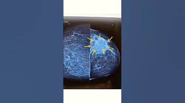 fat necrosis in mammography & breast ultrasound