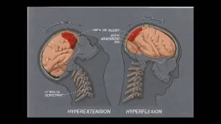 The Law Show Ep. 39 Pt. 1 Concussions And Brain Injuries, Car Technology And Personal Injury