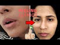 FIZ PEELING QUÍMICO, PELE DE BEBÊ | Monique Cuman