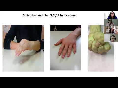 Ekstansör tendon tamiri sonrasında rehabilitasyon-Prof.Dr.Çiğdem Öksüz