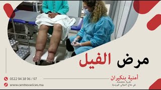 الدكتورة أمنية بنكيران :هام للنساء، أسباب مرض الفيل وأصنافه