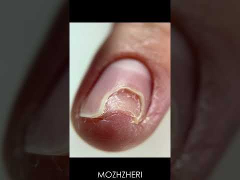 اونیکولیز مژری