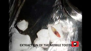 EXTRUSION OF LATERAL INCISOR /MANAGEMENT BY IMMEDIATE LOADING DENTAL IMPLANTS IN CHENNAI