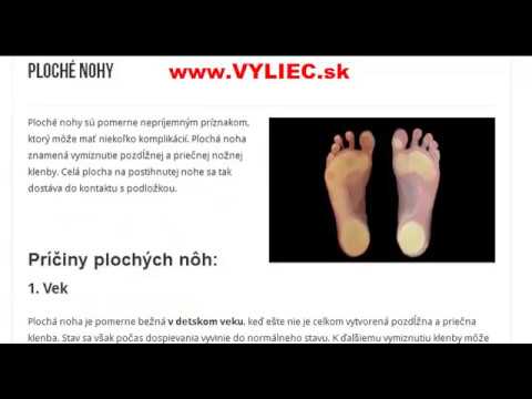 Video: Ako diagnostikovať ploché nohy?