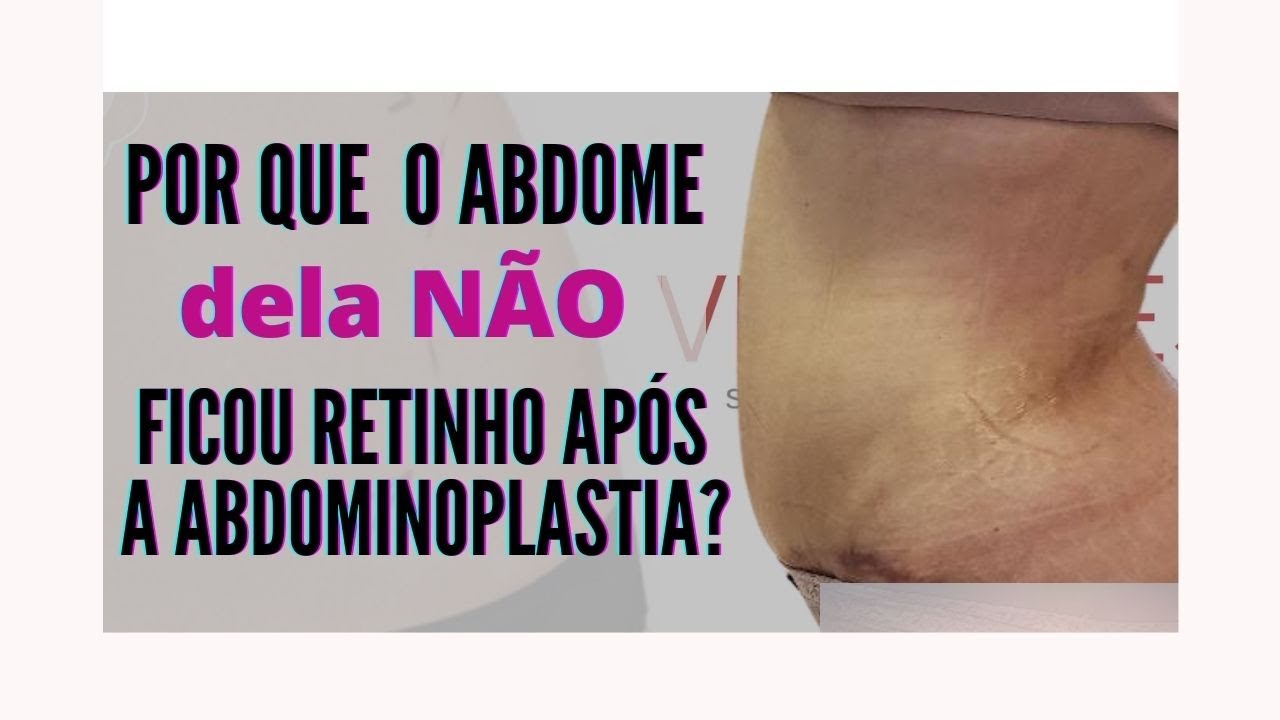 Resultados de abdominoplastia: por que o abdome dela não ficou retinho?