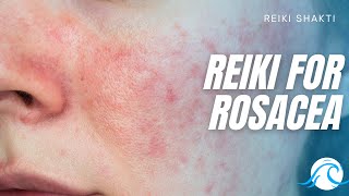Reiki for Rosacea - Powerful Energy Healing