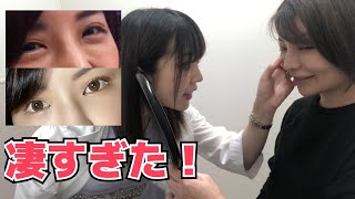 【目の下のふくらみ】取ったら人生変わった