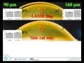 Comparison of spherical aberration induction between SMILE and LASIK