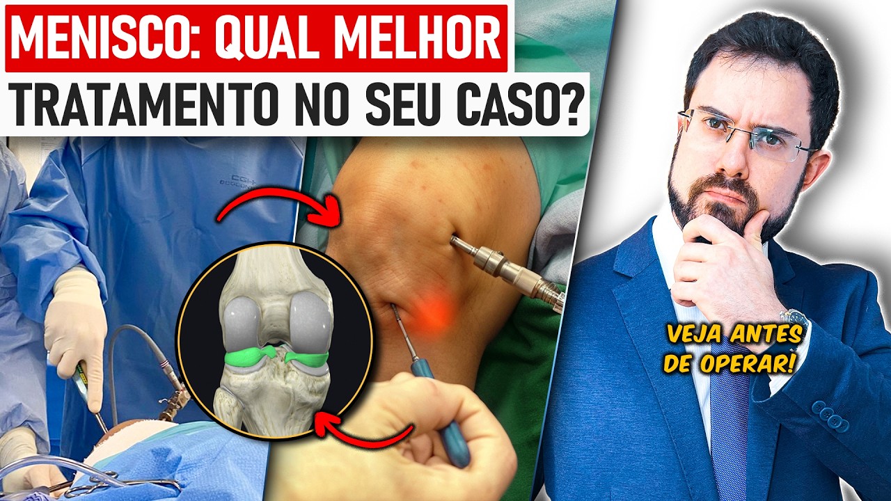 Lesão de Menisco: Quem DEVE OPERAR e como é a cirurgia [Aulão c ...