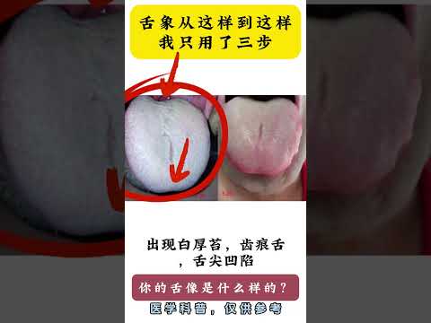 舌象从这样到这样，我只用了三步,健康养生,中医药