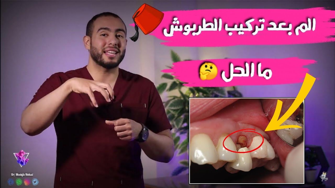 ٦ اسباب لألم الاسنان بعد التركيبات الثابته والطربوش  ( التلبيسه ) | علاج الم الضرس بعد تركيب الطربوش