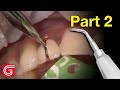 HOW TO Remove Old PFM Crowns on ANTERIOR  Teeth
