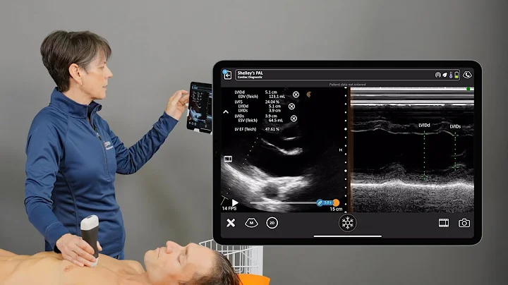 Fractional Shortening