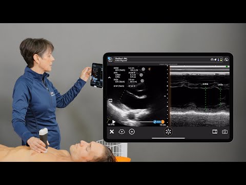 Image of Fractional Shortening