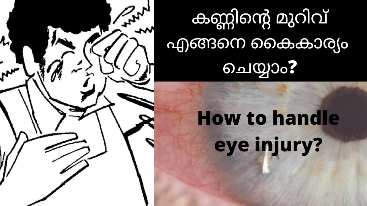 How to handle emergency situations for eye like chemical splash ,eye