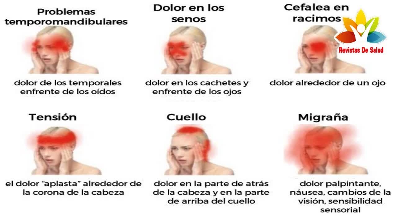Estos son los tipos de dolores de cabeza más comunes y aquí está como
