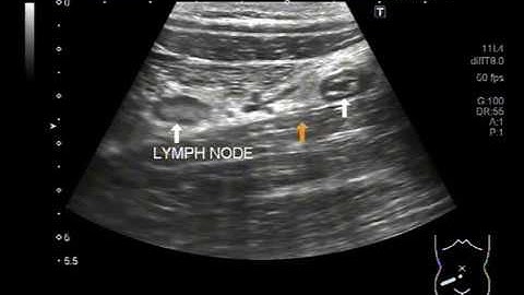 Ultrasound Video showing inflamed appendix with prominent lymph nodes in the adjacent area.