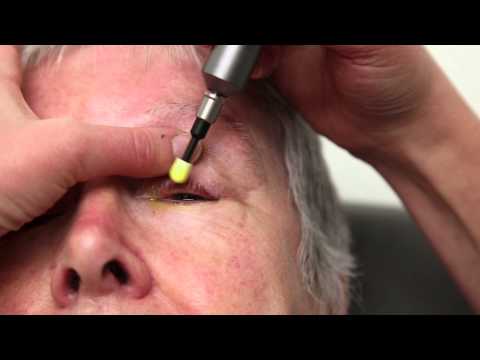Video Facial Sauna For Blepharitis 