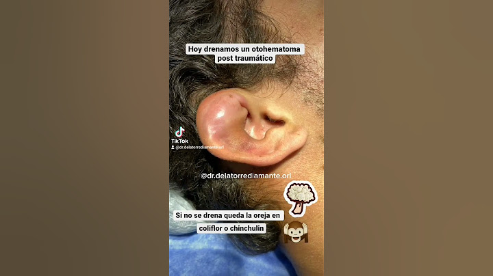 Otohematoma, antes y después.