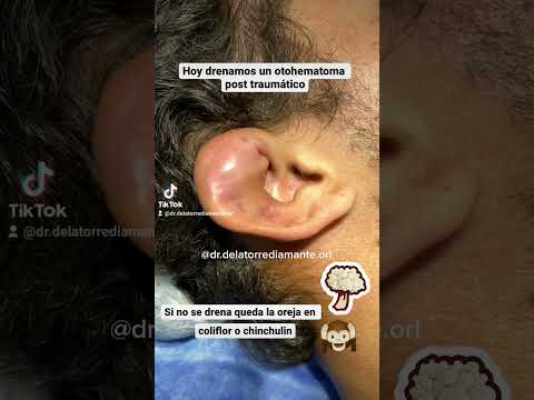 Video: Hematoma del oído (auditivo)