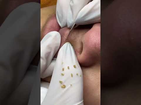 Limpieza Facial - Extracción de Granos