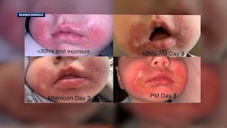 Boston Doctor Explains How To Treat, Prevent Margarita Burn