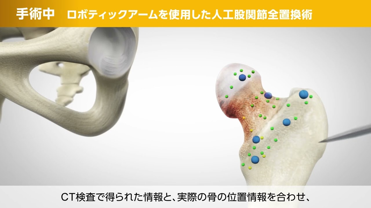 人工膝関節全置換術 - 一般財団法人脳神経疾患研究所 附属 南東北福島病院
