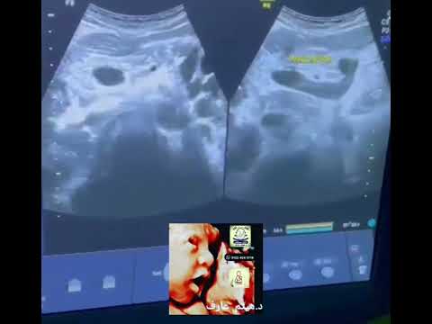 portal hypertension ultrasound by Dr.Haissam Aref ,DMS, MSc MD ultrasound