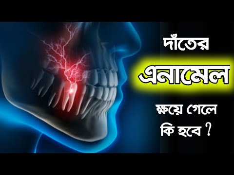 ভিডিও: ডেন্টাল ইনলে কি?