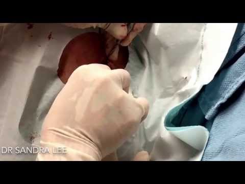 Cyst Within A Scar, Excised.  For Medical Education- NSFE.