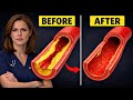 One Fruit CLEARS Arterial Buildup When Numbers Look Perfect