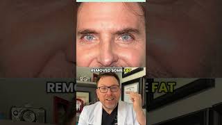 The CORRECT Way to do Male Blepharoplasty #jimcarrey #bradleycooper #plasticsurgery