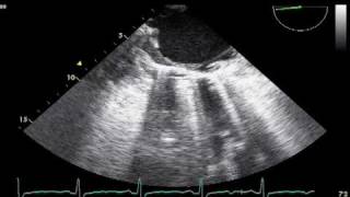 Rt Pleural Effusion?